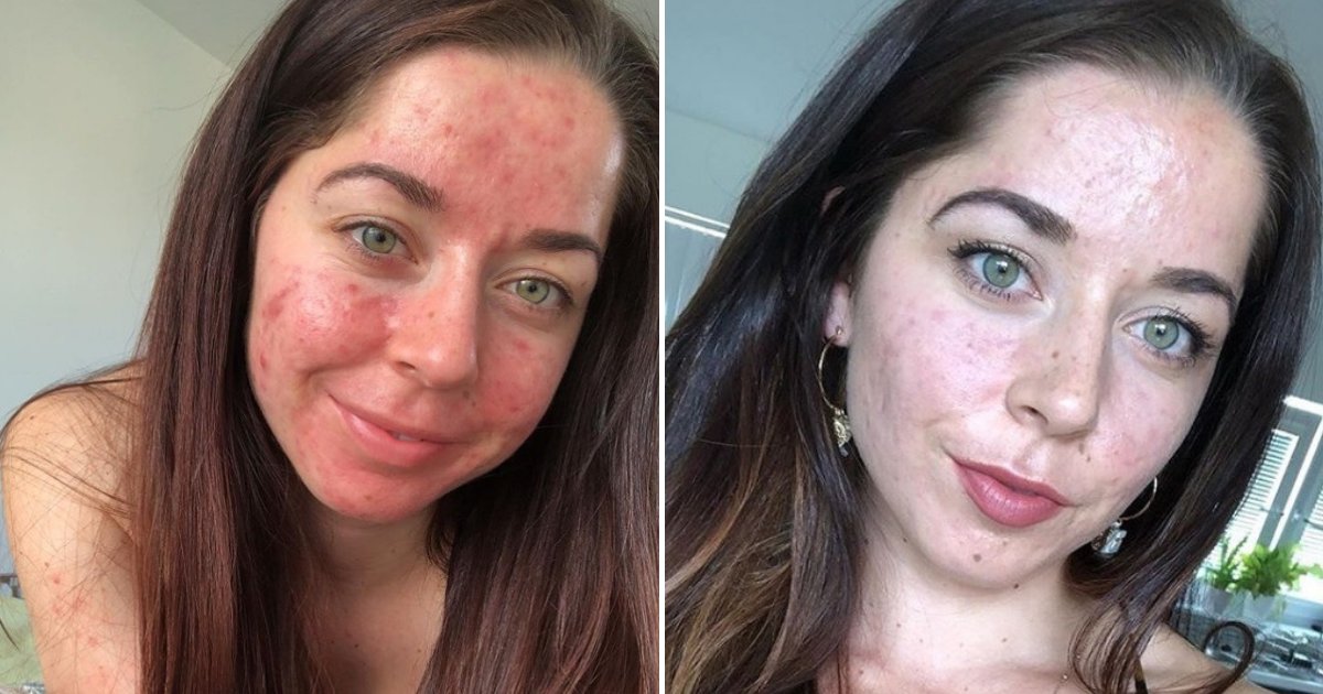 untitled design 77 1.png?resize=1200,630 - Une femme souffrant d'acné sévère a courageusement partagé ses photos en ligne