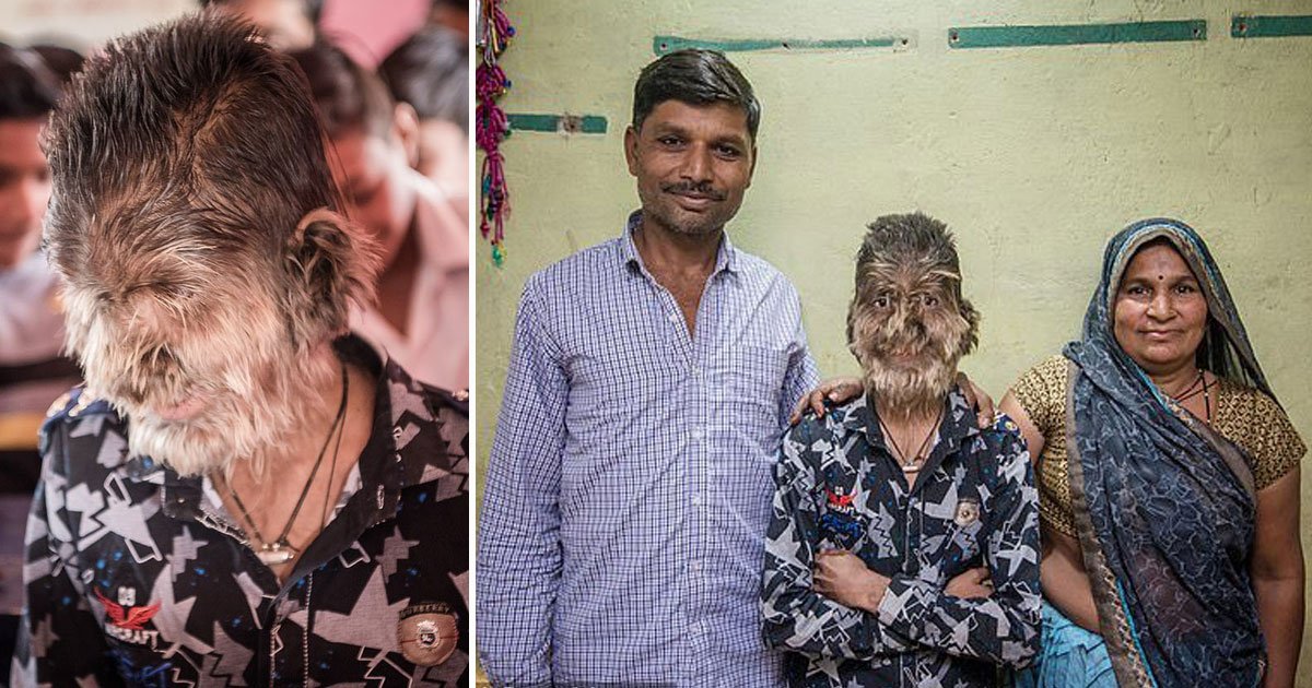 werewolf syndrome.jpg?resize=412,275 - 13-Year-Old Boy Suffers From ‘Werewolf Syndrome’ And Has His Face Covered In Hair