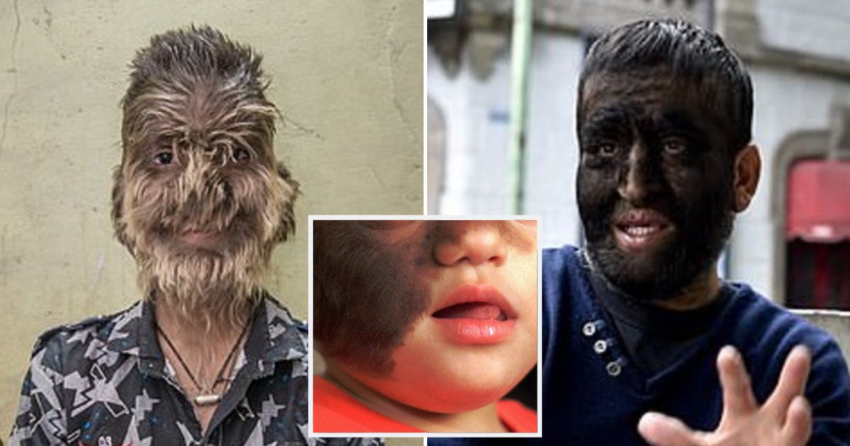 werewolf5.png?resize=412,275 - 16 Babies Developed Rare Condition Dubbed As 'Werewolf Syndrome' After Taking Contaminated Medication