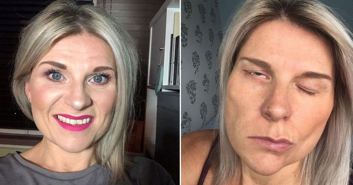 woman face paralyzed.jpg?resize=412,275 - Woman - Who Had A Cough - Woke Up With Half Her Face Paralysed
