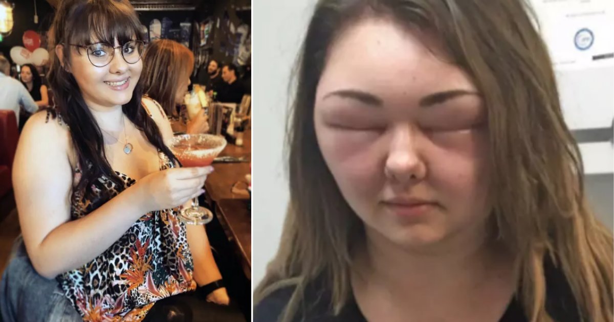 y 1 1.png?resize=1200,630 - Woman Allergic to Hair Dye Got Her Face Swollen Triple its Size After Getting Her Hair Dyed