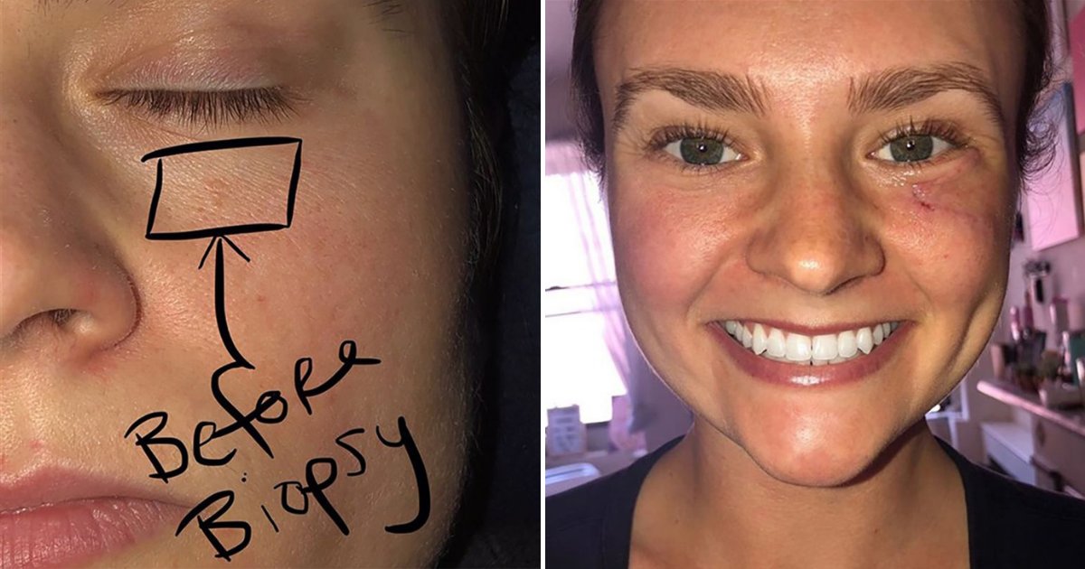 woman-s-small-pimple-under-her-eye-turned-out-to-be-skin-cancer-small