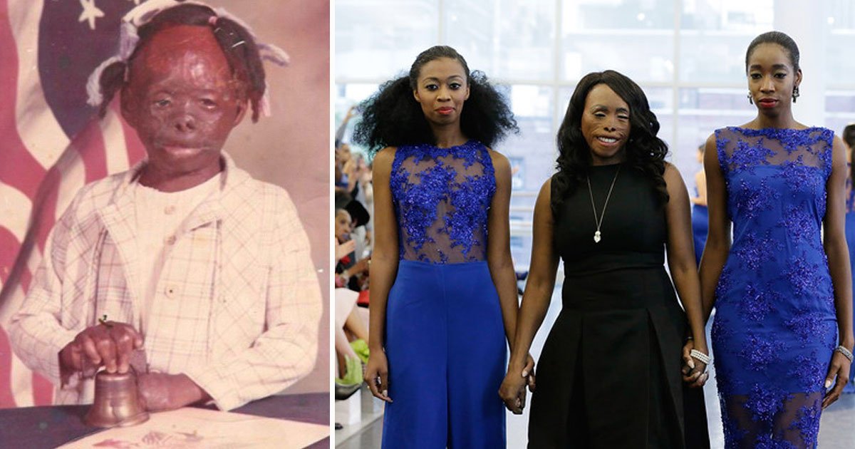 linda rowe thomas.jpg?resize=412,275 - Third Degree Burns Survivor Defied The Odds By Becoming A Celebrity Fashion Designer