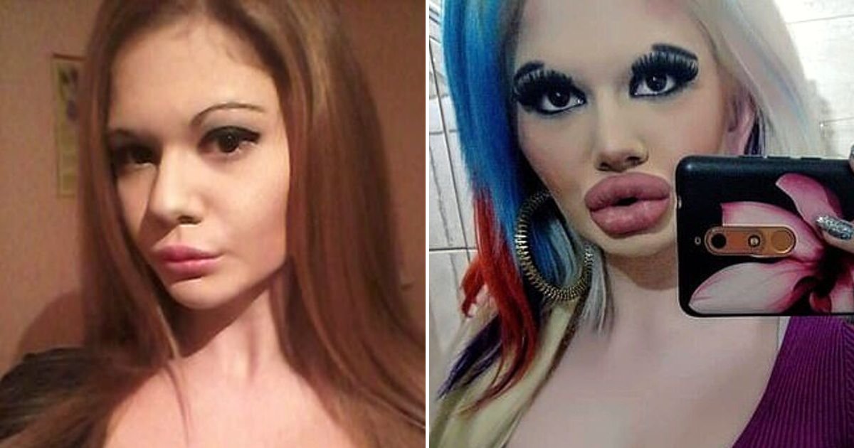 lips7.png?resize=1200,630 - Une femme de 22 ans a dépensé des milliers d'euros pour tripler la taille de ses lèvres
