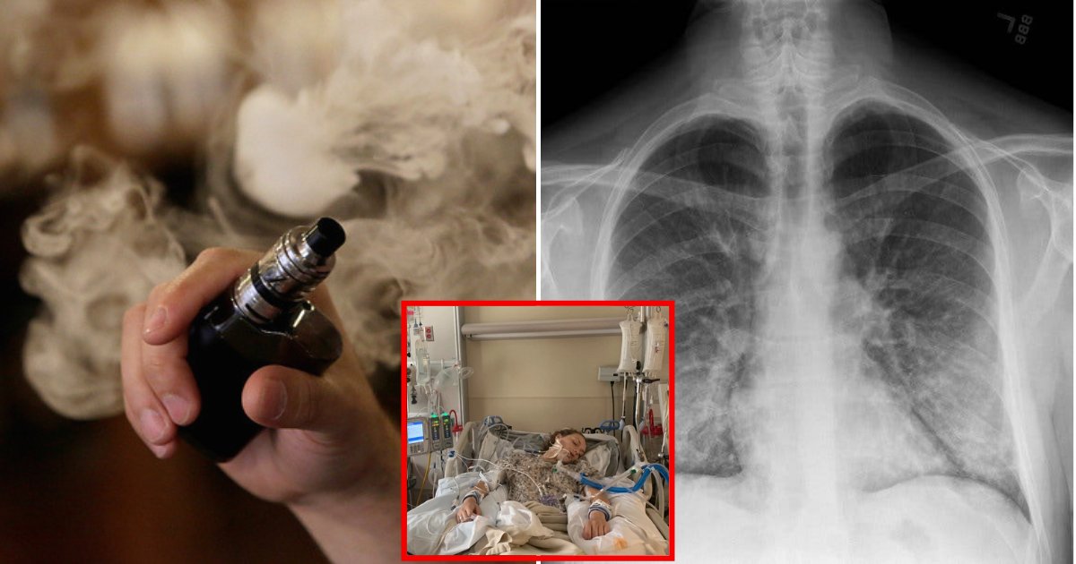 A Second Person Has Passed Away From Mysterious Lung Illness Linked To ...