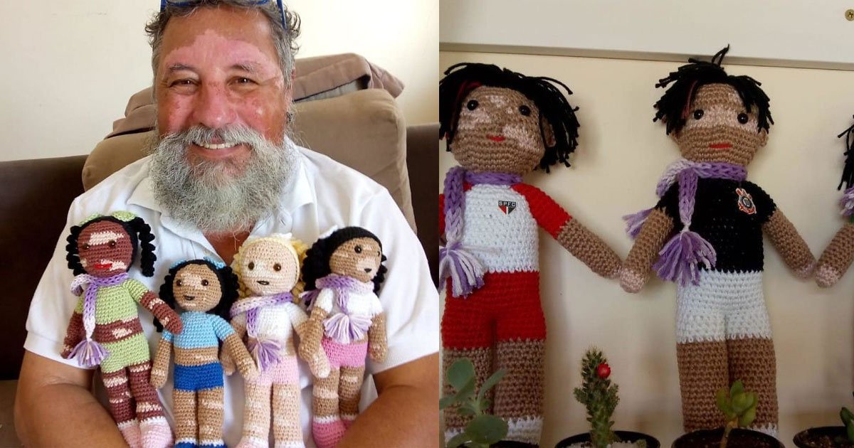 man with vitiligo knits dolls to make children with this condition feel normal and valued.jpg?resize=412,275 - Il valorise la différence avec ses poupées vitiligo