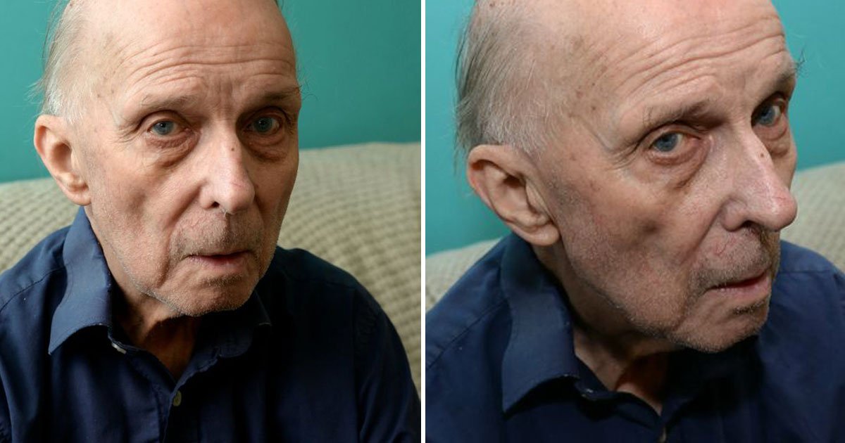 pensioner lump head.jpg?resize=1200,630 - Pensioner Developed An Orange-Sized Lump On His Head After Falling Over At Wife’s Funeral
