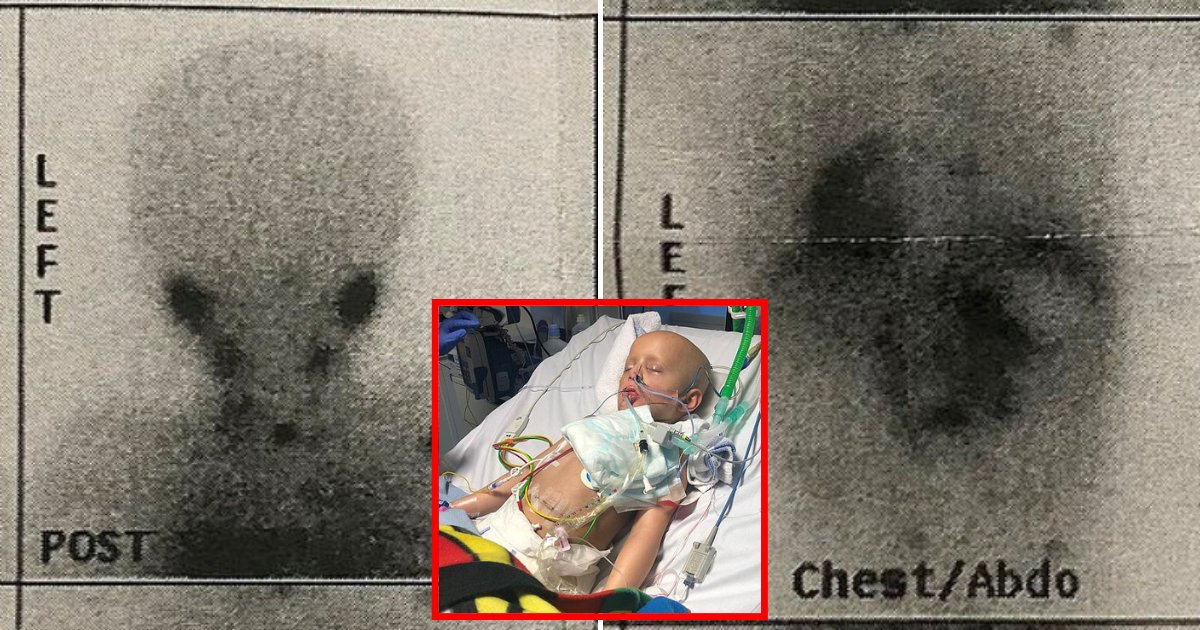 scan3.png?resize=412,275 - 5-Year-Old Boy Riddled With Cancer From ‘Nose To His Knees’ Regained His Strength