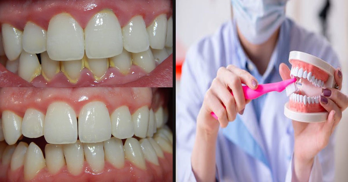 untitled 1 122.jpg?resize=1200,630 - Voici des astuces pour prendre soin de votre bouche et de vos dents