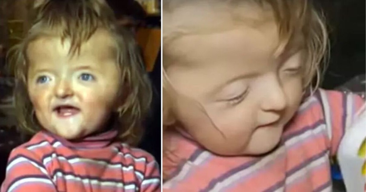 y 2 2.png?resize=1200,630 - Toddler Banned From Nursery Because of Her Deformed Skull
