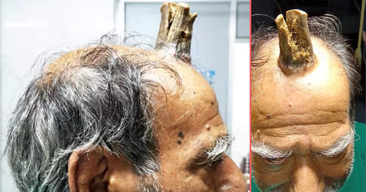 y1 14.png?resize=1200,630 - A Surgeon Operated And Removed A 4 Inch Horn Growing From A Farmers Head