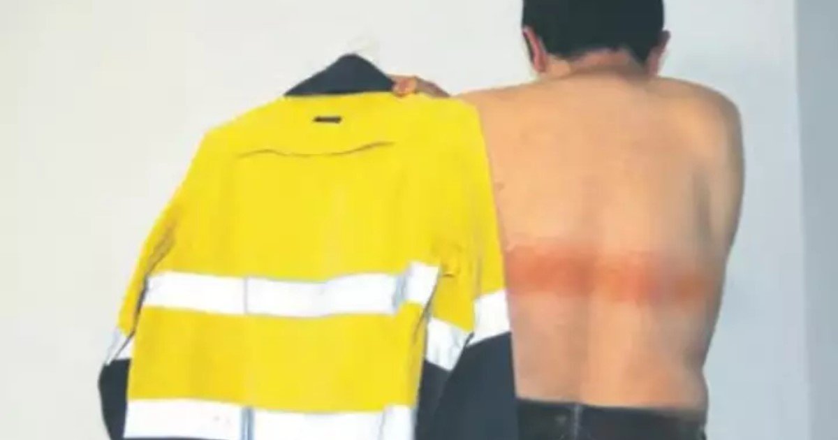 a 32.jpg?resize=1200,630 - A Man Left With First Degree-Burns From The Reflective Strip Of His High-Visibility Vest