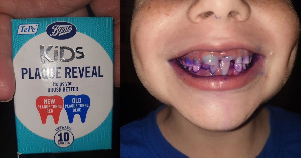 a mom shared how chewable dental tablets helped her son to see if he has brushed his teeth properly or not.jpg?resize=1200,630 - Des chewing-gums révèlent si oui ou non votre enfant s'est brossé les dents