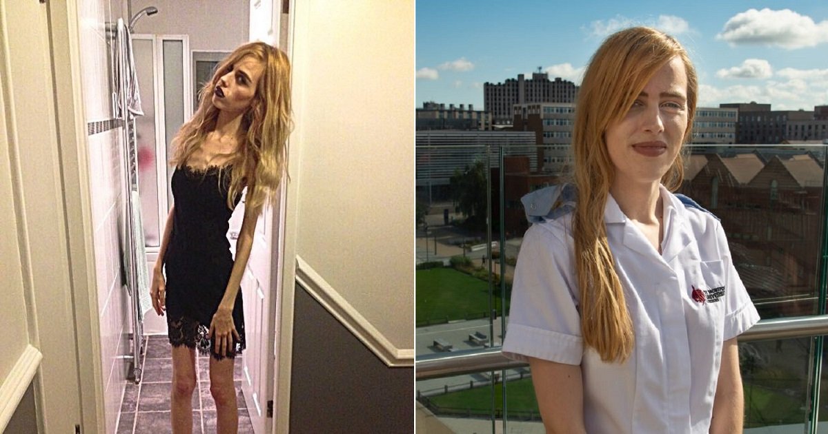 a3 4.jpg?resize=412,275 - A Former Anorexia Turned Her Life Around To Help Others By Becoming A Mental Health Nurse