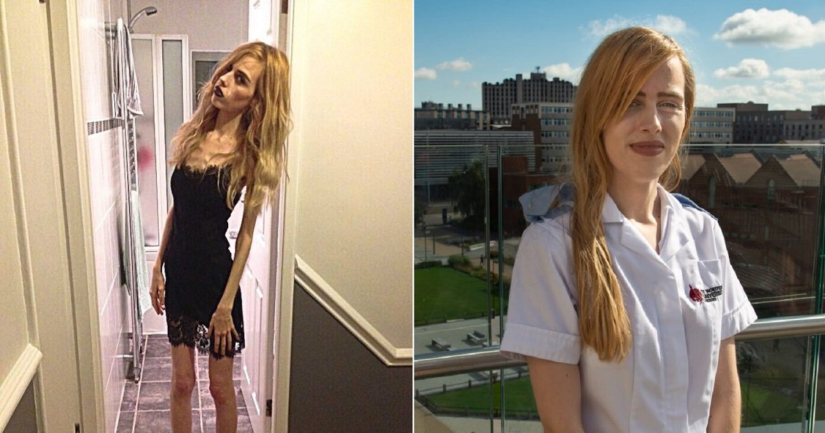 a3 4.jpg?resize=412,232 - A Former Anorexia Turned Her Life Around To Help Others By Becoming A Mental Health Nurse