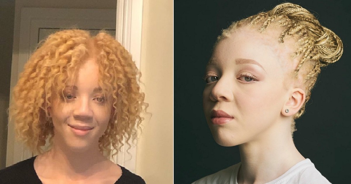 a4 2.jpg?resize=412,275 - Une adolescente souffrant d'albinisme a poursuivi son rêve de devenir un mannequint