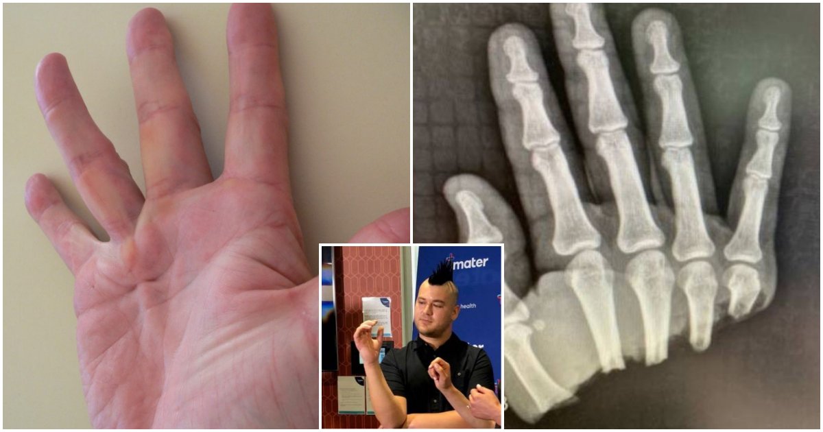 collage2.png?resize=412,275 - Man Who Had Lost His Hand Wiggled His Finger Within a Day of Surgery
