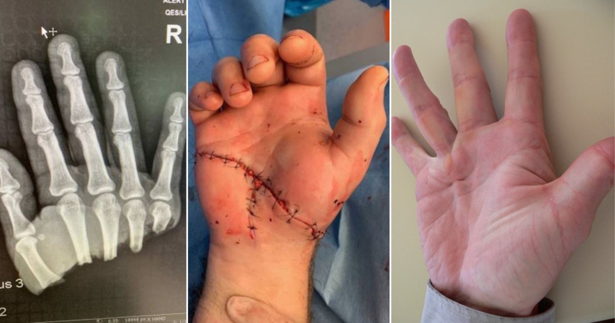 d 1 8.png?resize=1200,630 - Un homme qui s'était coupé la main a réussi a remuer ses doigts après son opération
