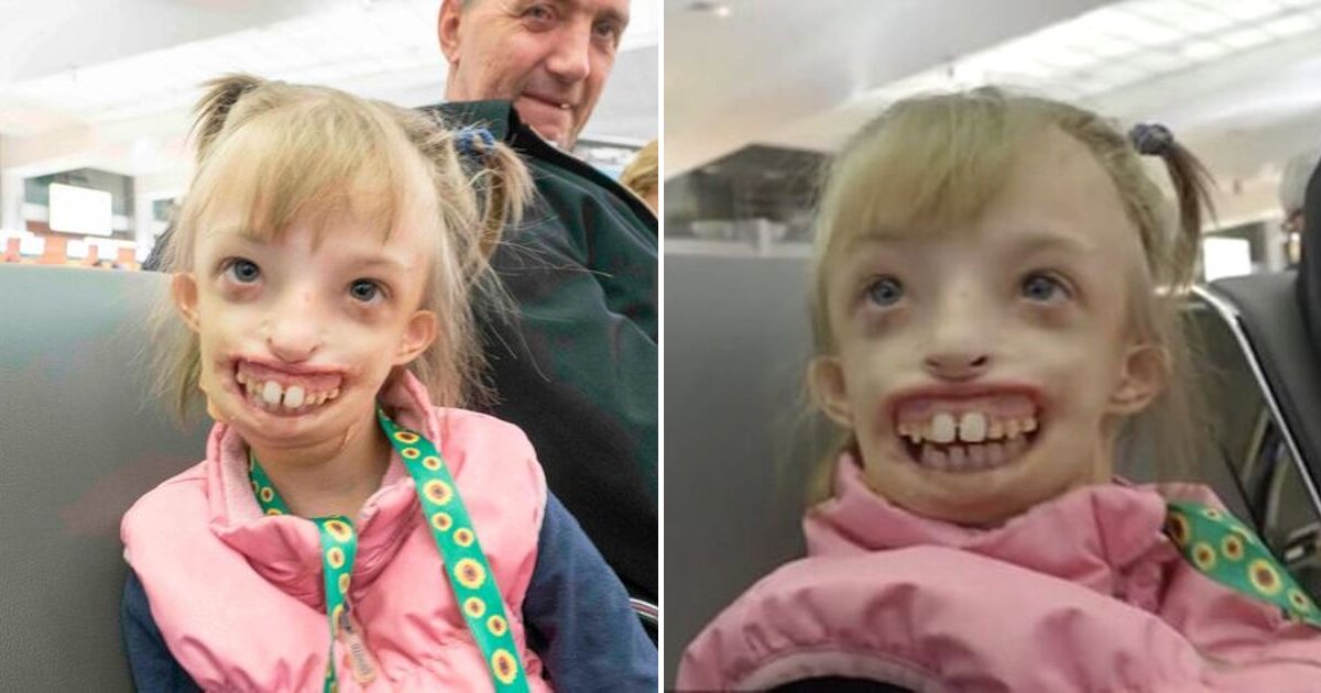 darina6.png?resize=412,275 - Girl Born With Half A Face Can Now Smile for The First Time After A Successful 11-Hour Operation