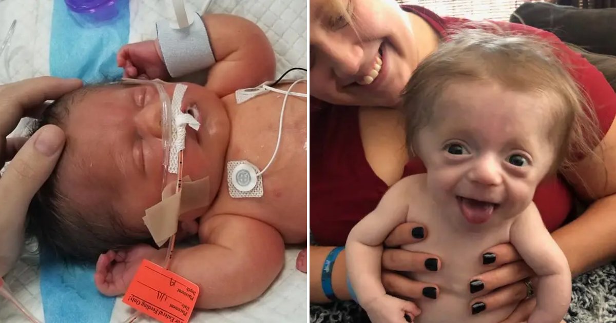 leo6 1.png?resize=412,275 - Doctors Told Mom She Should Abort 'Broken And Breaking ' Baby, Months Later He Defied The Odds