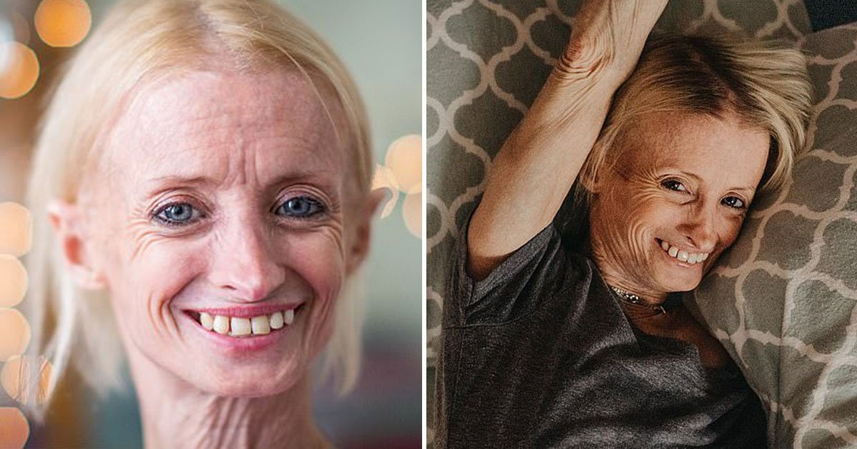 oldest survivor benjamin disease.jpg?resize=1200,630 - The Oldest Known Survivor Of Progeria Has Been Living Her Life To The Fullest