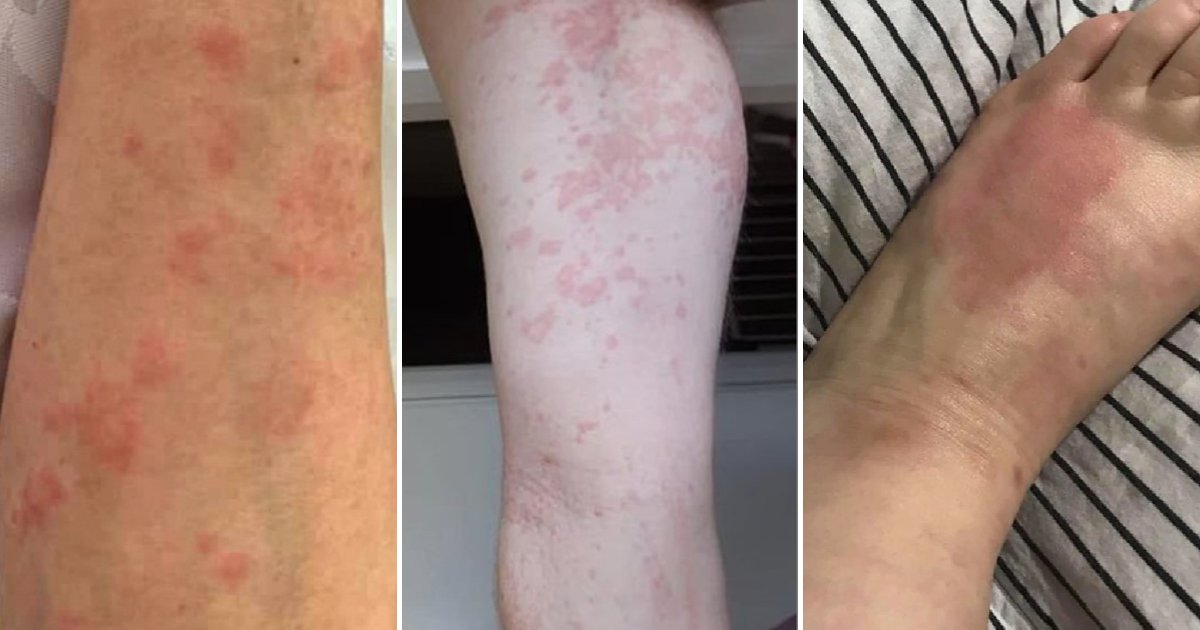 rash5.png?fit=1024%2C538&ssl=1&strip=all - Hundreds Of People In Australia Are Struck Down By An Incurable And Mysterious Rash
