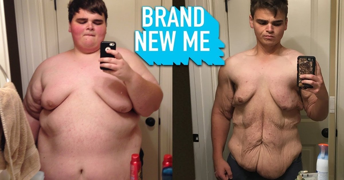 s3 14.jpg?resize=1200,630 - “It’s Almost A Trophy”: A Young Man Who Lost 230 Lbs. Isn't Bothered By His Excess Skin