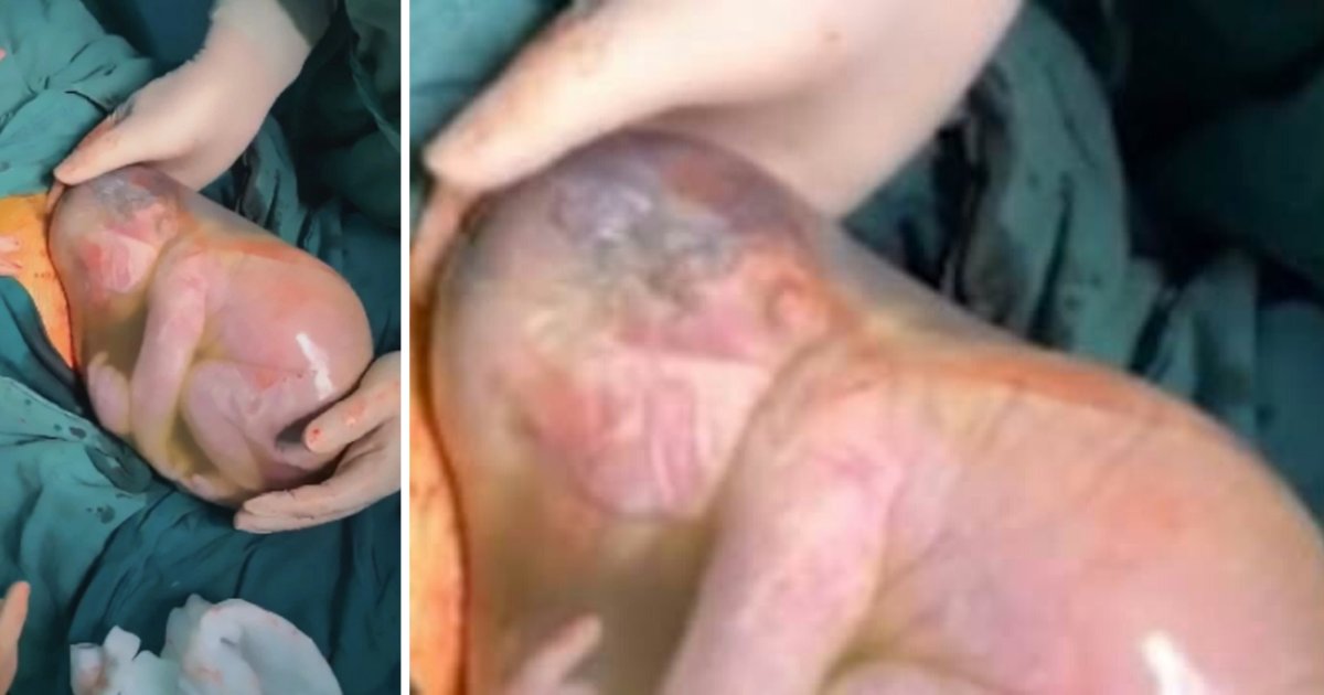 untitled design 1 14.png?resize=412,275 - Baby Boy Born Inside Amniotic Sac in China