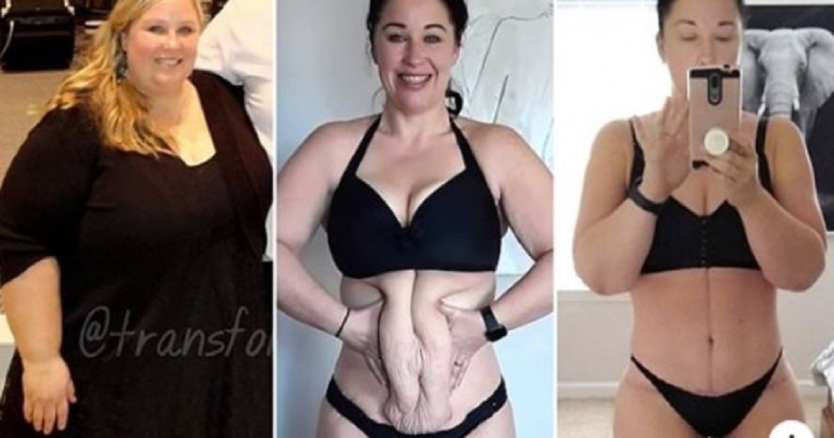 w3 2.jpg?resize=412,275 - A Woman Lost An Incredible 234 Lbs. But Had To Undergo Surgery To Remove The Excess Skin