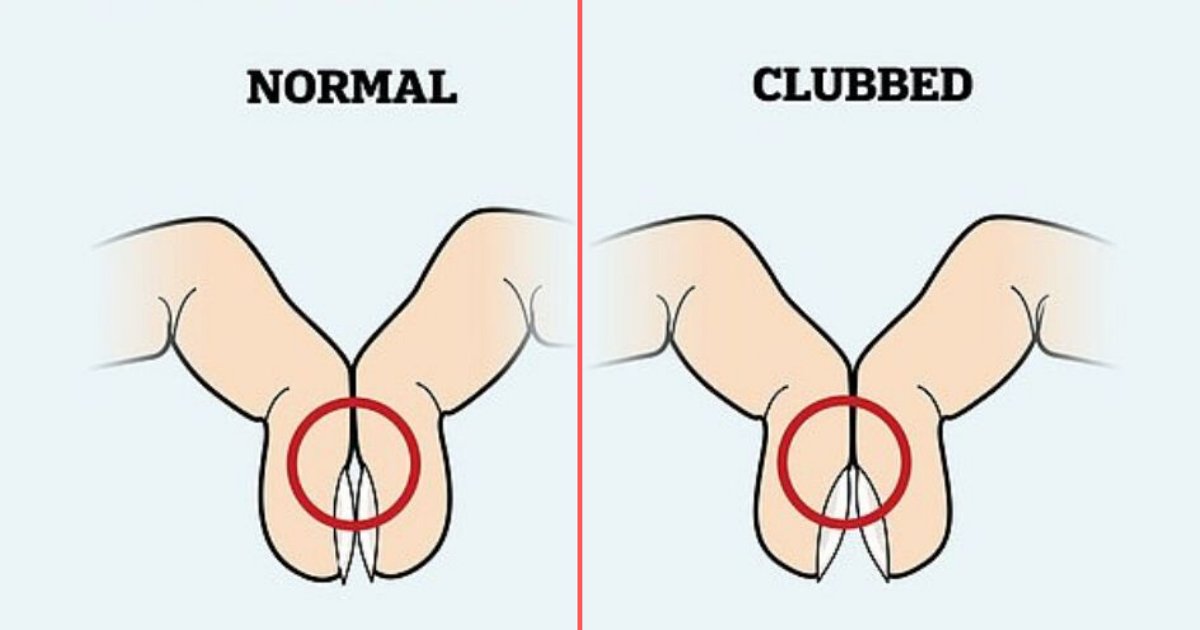 1 30.png?resize=412,275 - Simple Fingernail Test Could Potentially Reveal The Possibility of Lung Cancer Said Nurse