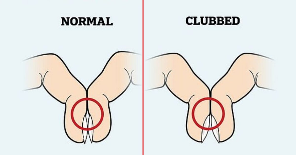 1 30.png?fit=1024%2C538&ssl=1&strip=all - Simple Fingernail Test Could Potentially Reveal The Possibility of Lung Cancer Said Nurse