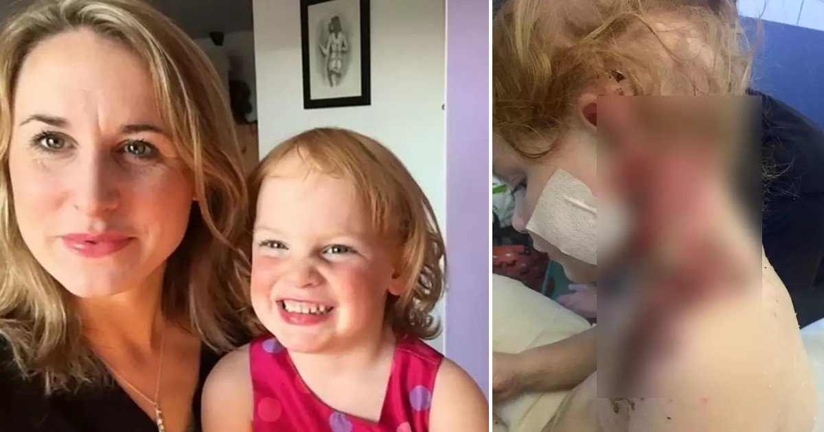 a 17.jpg?resize=412,275 - A Mom Called For A Ban On Public Sale Of Fireworks After Her Daughter Was Left With Life-Long Scars