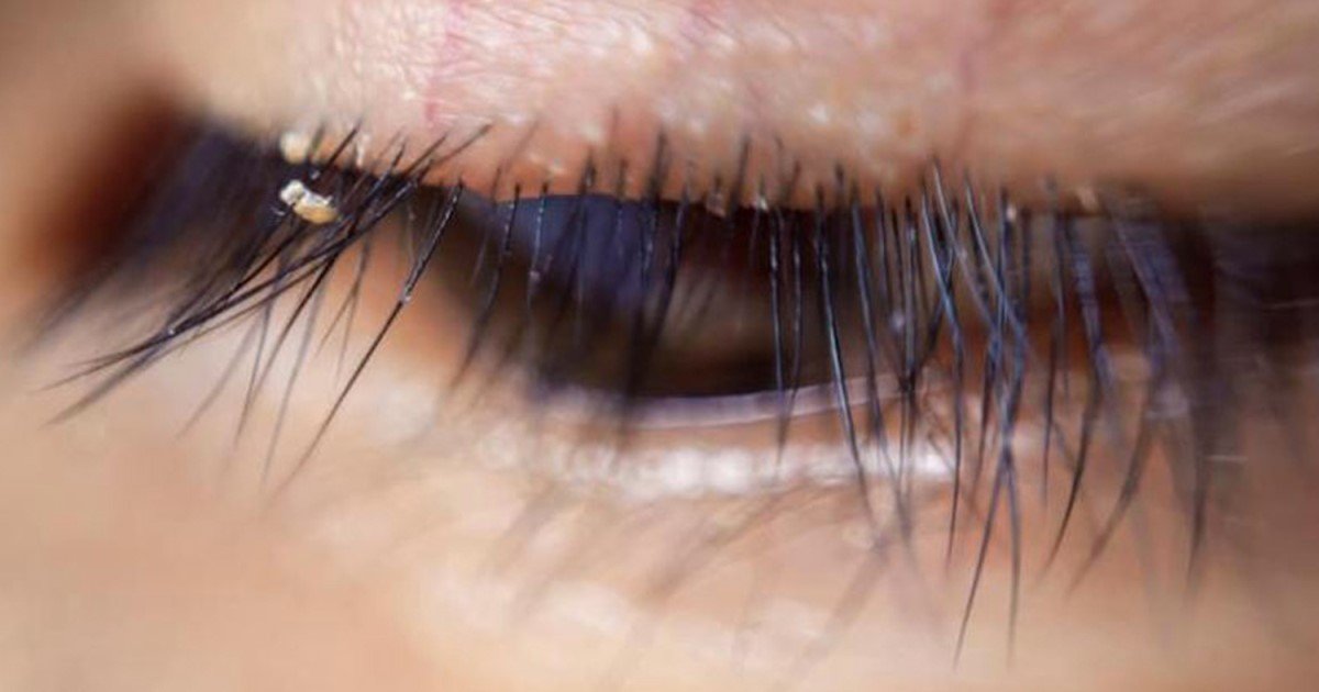 a 74.jpg?resize=1200,630 - Not Washing Eyelash Extensions Could Make Them Be Home Of 'Lash Lice,' Doctor Revealed