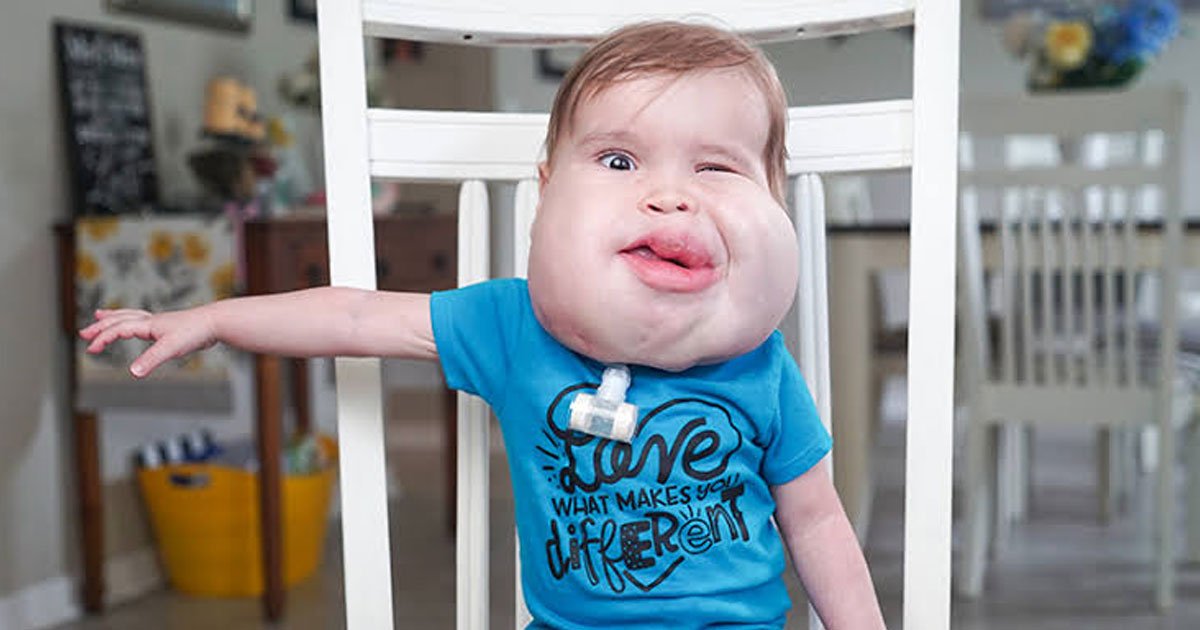 boy with facialcysts.jpg?resize=412,275 - Parents Of Eighteen-Months-Old Boy With Facial Cysts Are Sharing Their Son’s Story To Help Other Parents