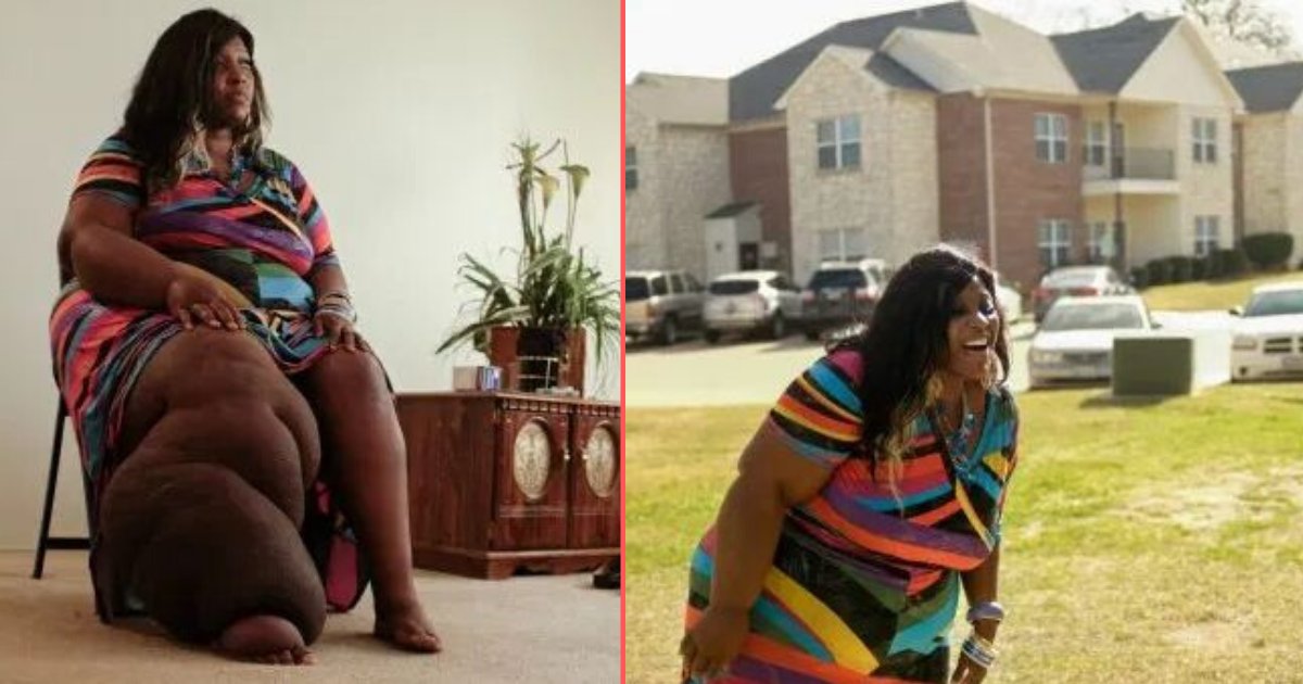 d 6 1.png?resize=412,232 - Texas Woman With Rare Disorder Inspires Others Despite Large Swelling: Here’s The Story