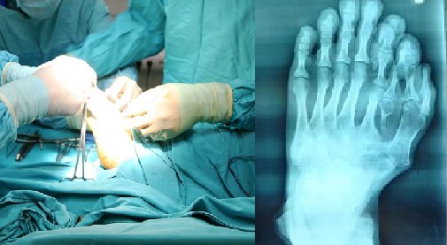footsurgery.png?resize=412,232 - A Man Born With 9 Toes On His Left Foot Underwent A Life-Changing Surgery