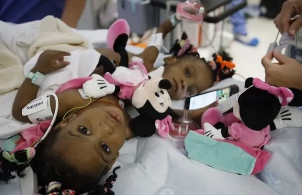 siamoise.jpg?resize=412,232 - Ces deux petites filles siamoises sont maintenant séparées grâce à une opération chirurgicale