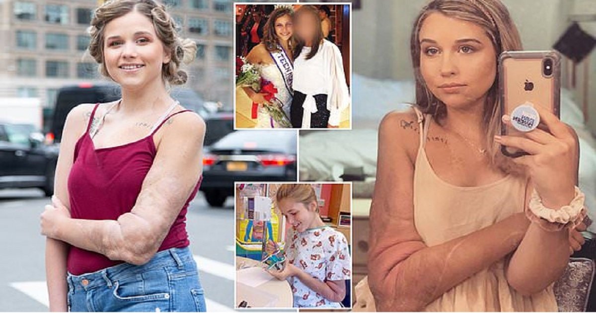 t4.jpg?resize=1200,630 - Incredibly Resilient Young Woman Became A Pageant Queen Despite Having Tumors Covering Half Her Body