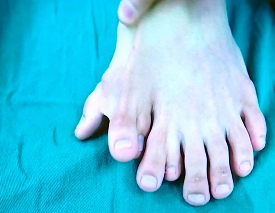 A Man Born With 9 Toes On His Left Foot Underwent A Life-Changing ...