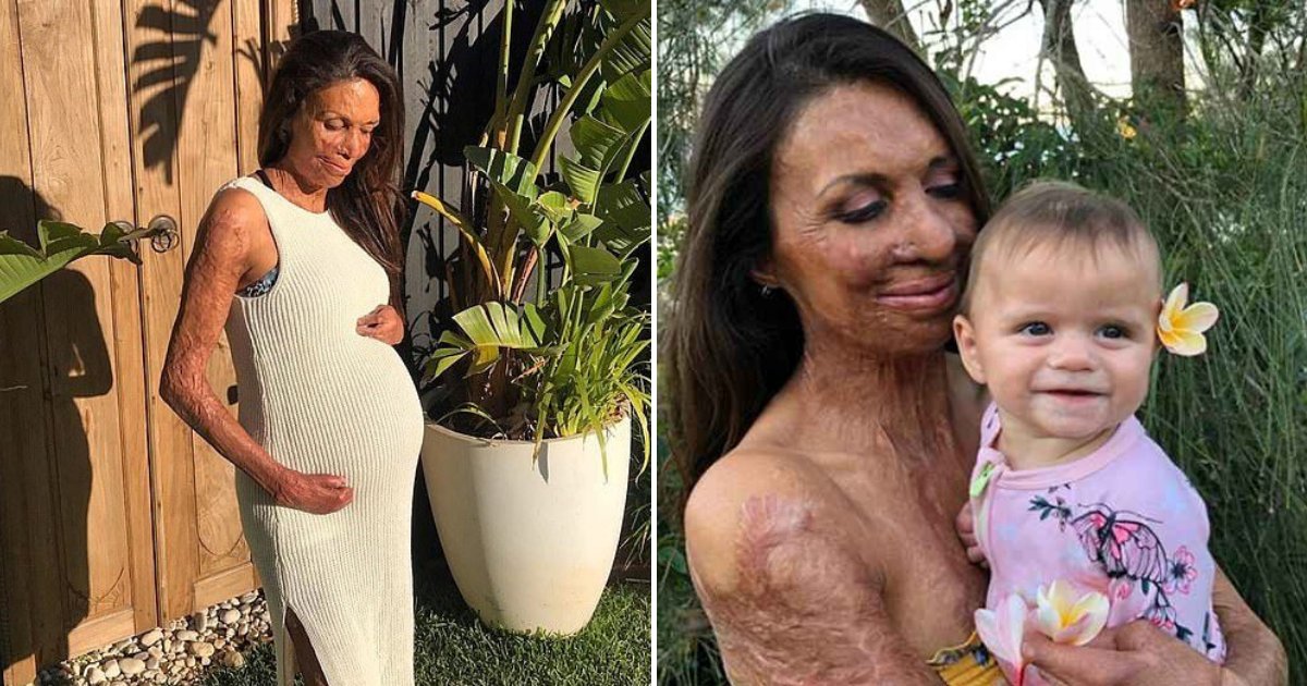 turia6.png?resize=412,275 - Woman Who Survived Wildfire Was Told That She Looked Like A 'Can Of Baked Beans'