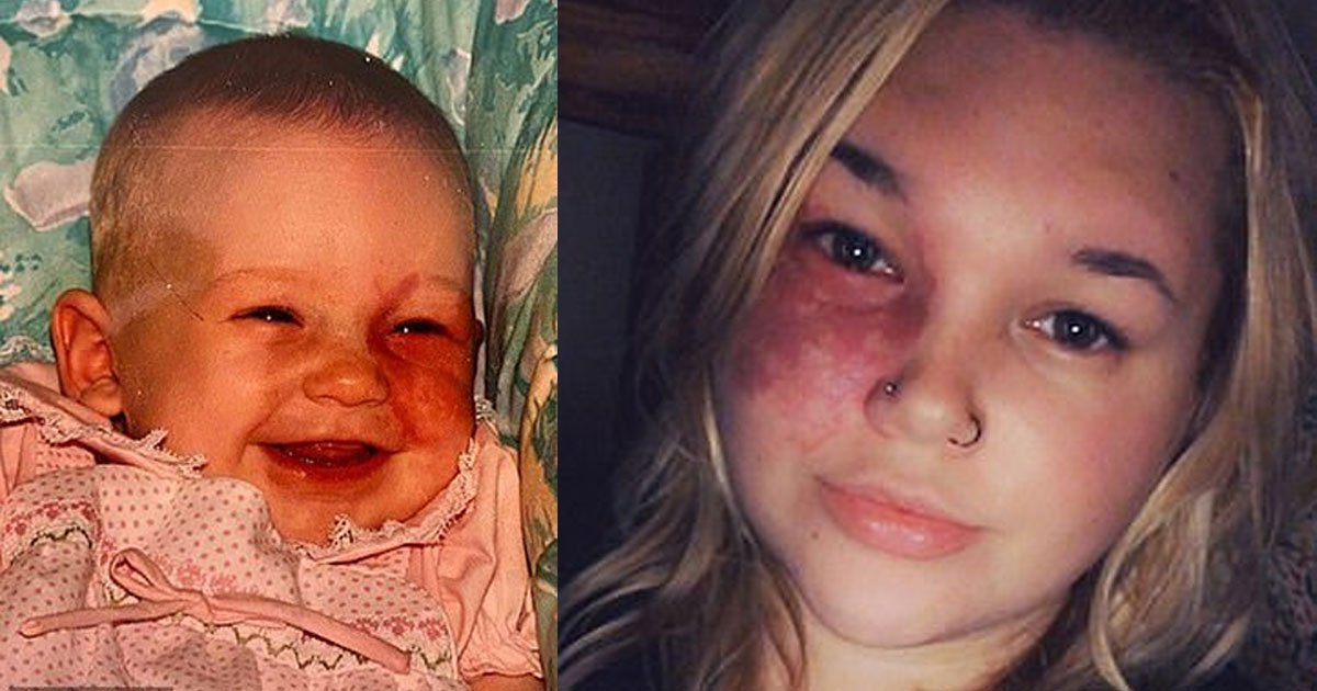 woman born with a facial birthmark chose not to have it removed because she likes to stand out from the crowd.jpg?resize=1200,630 - A Woman Born With A Facial Birthmark Chose Not To Have It Removed To Accept Her Unique Appearance