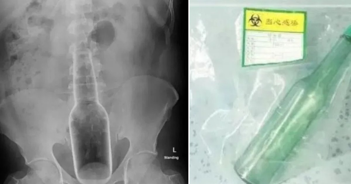 3 61.png?resize=412,275 - 60 Years Old Chinese Man Accidentally Slipped a Bottle Inside His Rectum