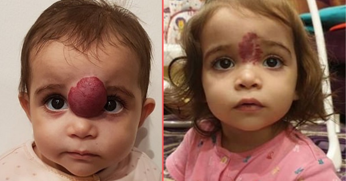 Une Enfant Avec Une Tumeur Au Visage Avait Une Grosse Bosse Violette Entre Les Sourcils Vonjour