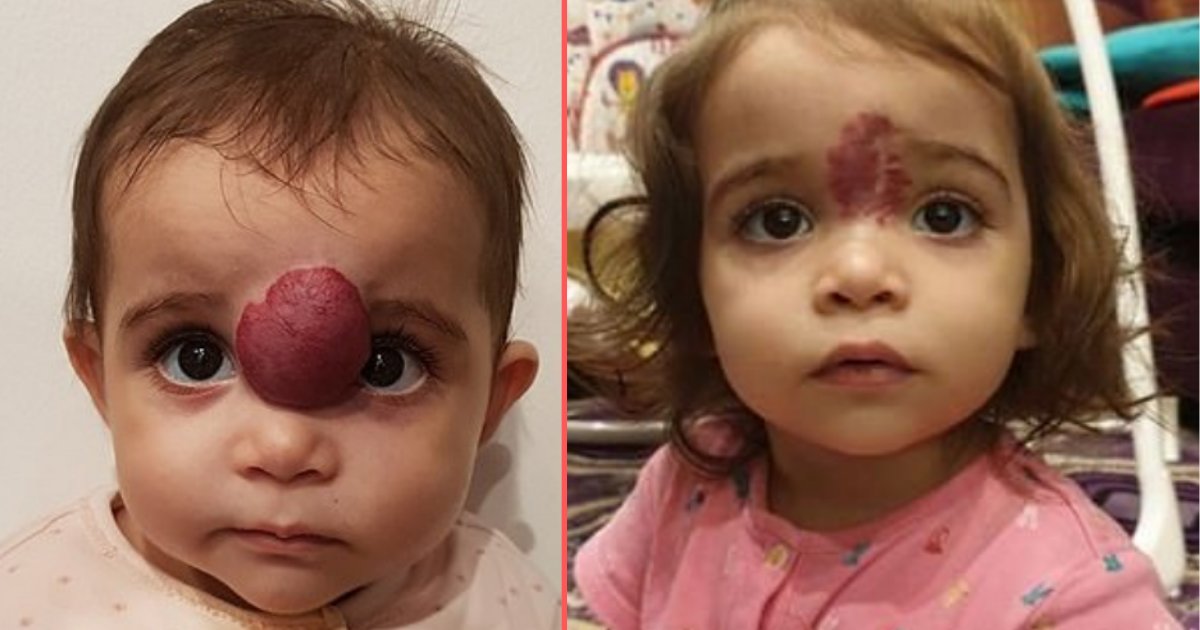 5 11.png?resize=1200,630 - Une enfant avec une tumeur au visage avait une grosse bosse violette entre les sourcils