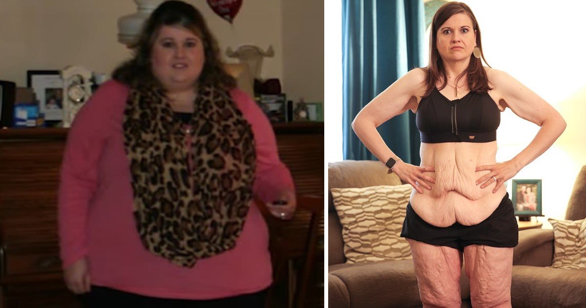 a 7.jpg?resize=412,275 - A Woman Lost 260lbs In An Unbelievable Transformation But Was Left With 20lbs Of Extra Skin