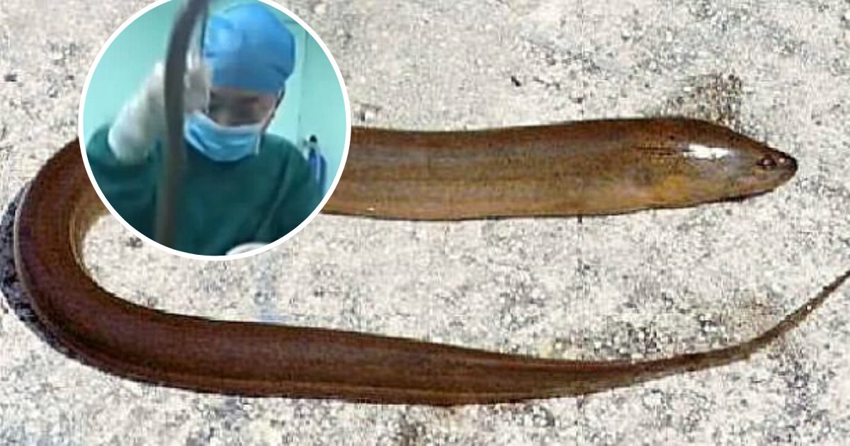 eel5.png?resize=1200,630 - Man Nearly Lost His Life After Putting A 20-Inch Eel Up His Backside To Treat Constipation