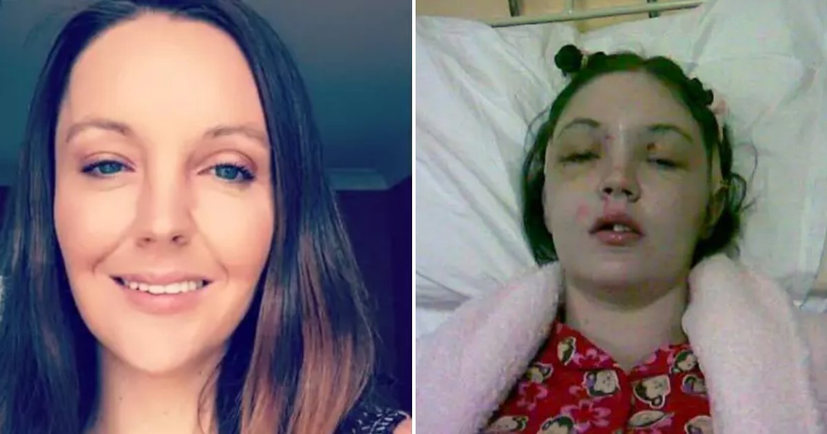 forehead6.png?resize=412,275 - Woman Who Lost Her Forehead After Car Crash Warns Others Not To Do The Same Mistake