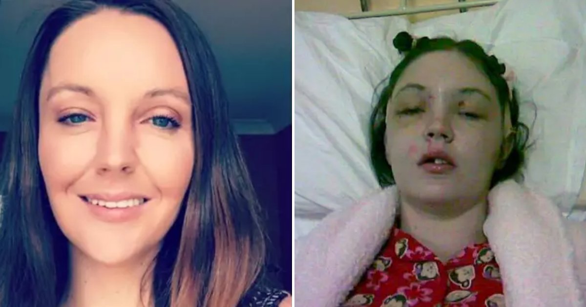 forehead6.png?resize=412,232 - Woman Who Lost Her Forehead After Car Crash Warns Others Not To Do The Same Mistake