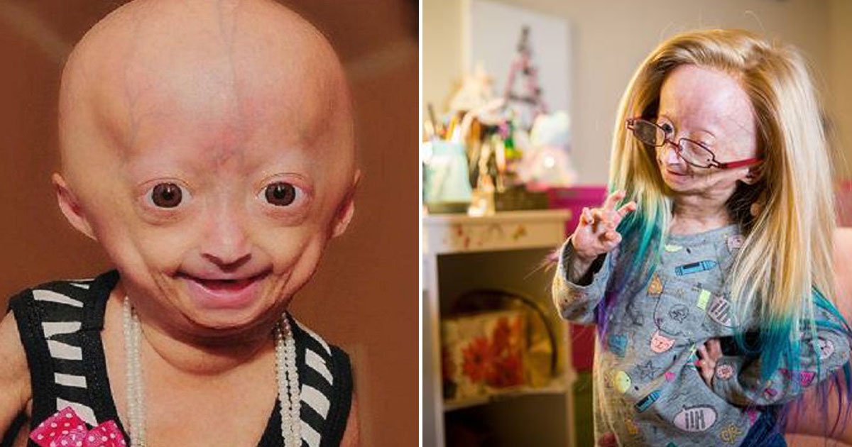 girl with rare condition.jpg?resize=1200,630 - Voici la vidéo adorable d'une fillette qui souffre d'une maladie congénitale rare