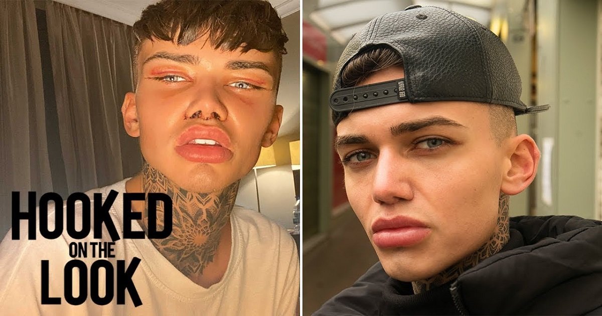 i3.jpg?resize=412,275 - Plastic Surgery Turned A Young Man's Face Into An Instagram Filter